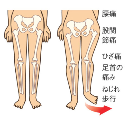 股関節サポーター